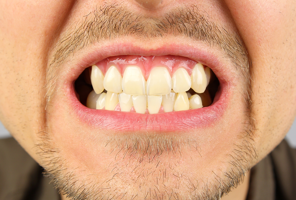 علائم دندان قروچه