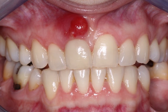 درمان التهاب دندان