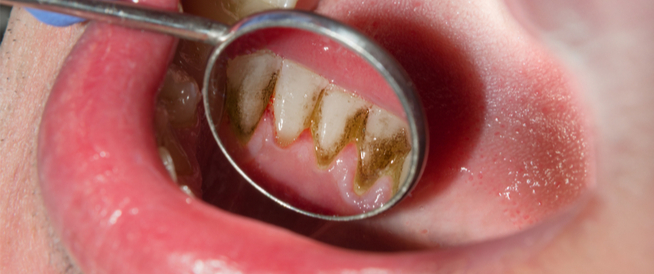 علت خراب شدن دندان از ریشه