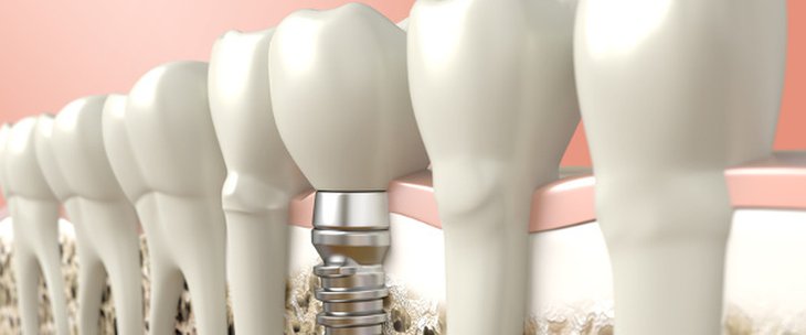 بهترین ایمپلنت دندان با ماندگاری بالا