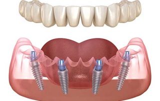 تفاوت ابمپلنت دندان
