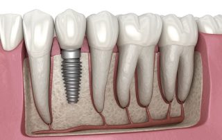 ایمپلنت دندانی معمولی
