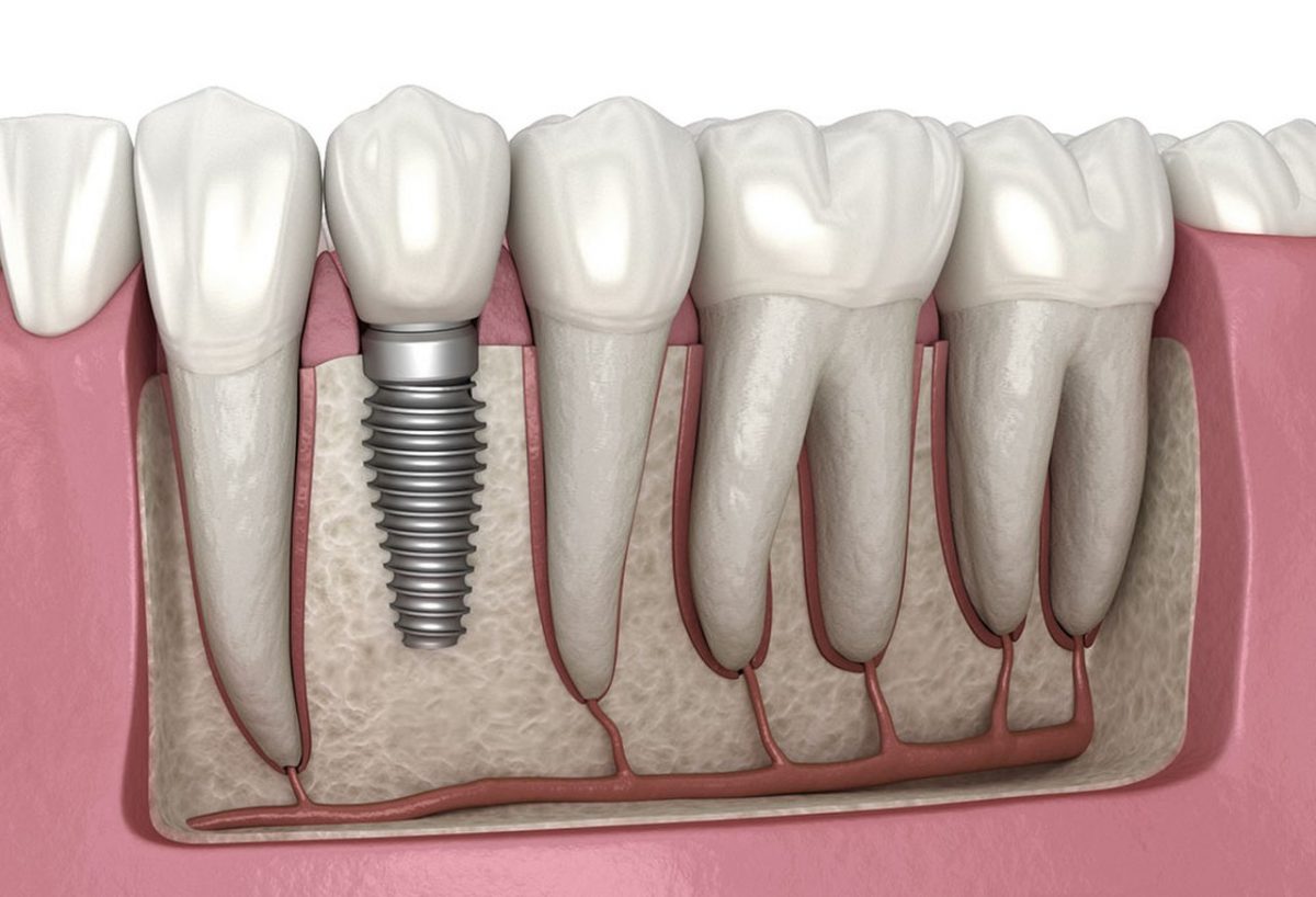 ایمپلنت دندانی معمولی