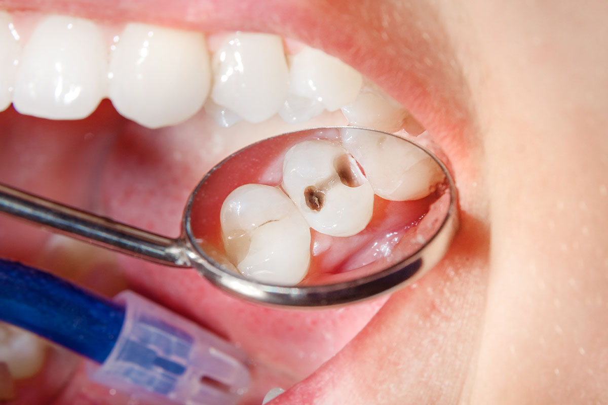درمان پوسیدگی دندان