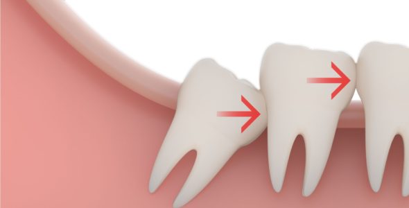جراحی دندان عقل نهفته یا نیمه نهفته