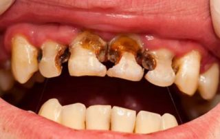 علت خراب شدن دندان