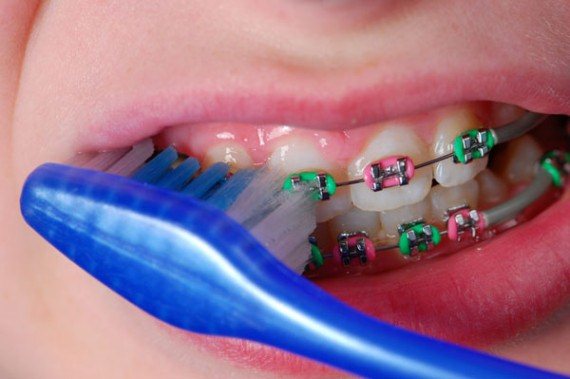 راه های نگهداری از ارتودنسی دندان