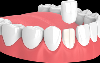 لمینت دندان چیست؟