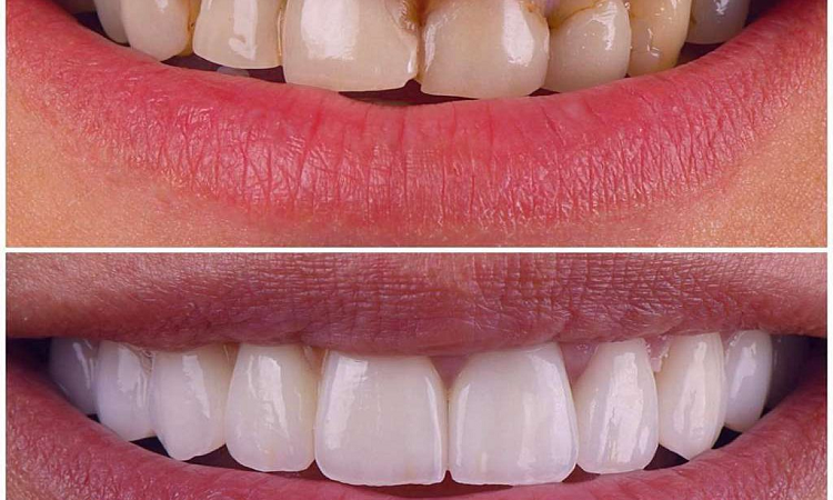 علت برجستگی دندان