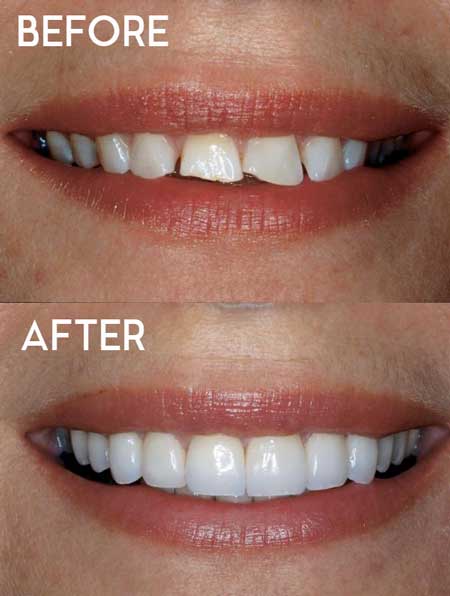 تغییرات دندان بعد از کاشت ایمپلنت
