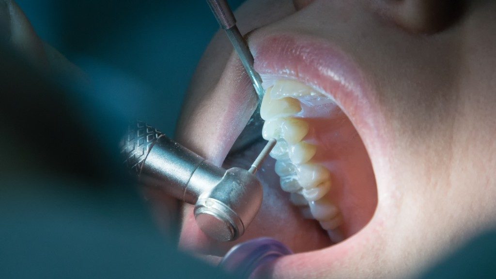 عوارض جانبی جراحی دندان عقل