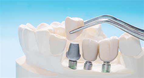 مراحل قرارگیری ایمپلنت دندان