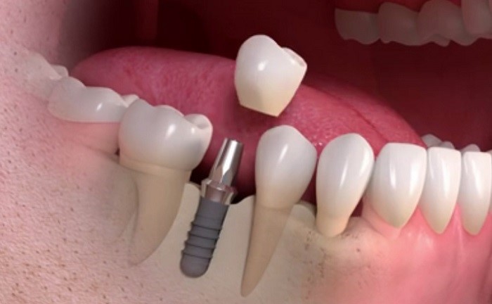علائم ناشی از شکست کاشت دندان