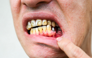 علت درد ایمپلنت دندان