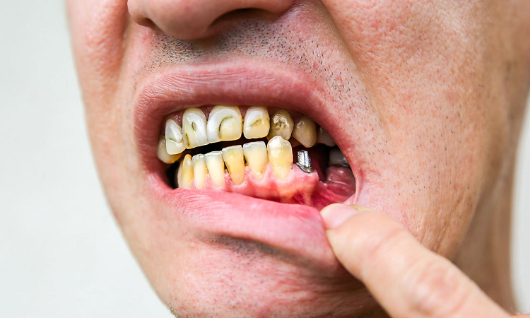 عوارض احتمالی کاشت دندان
