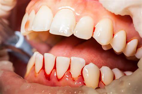 راه های درمان خونریزی دندان