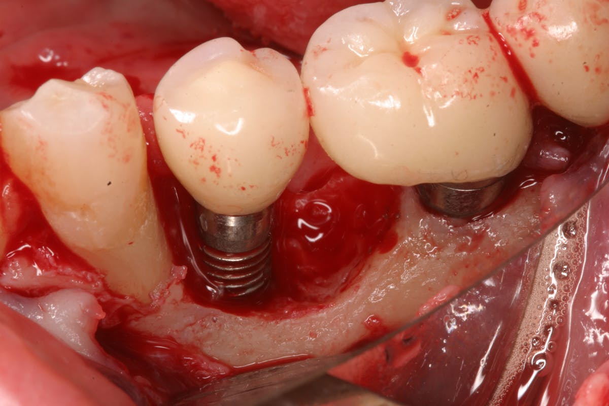 کاشت ایمپلنت دندان در فک
