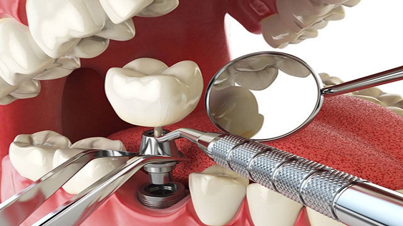 کاشت ایمپلنت دندان مرحله به مرحله