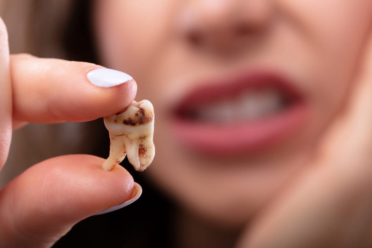 مزایا و معایب کشیدن دندان عقل