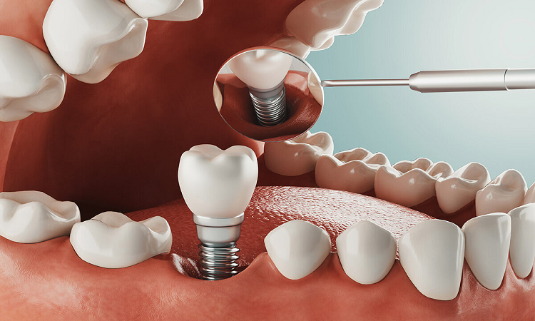 مراقبت از ایمپلنت دندان بعد از کاشت