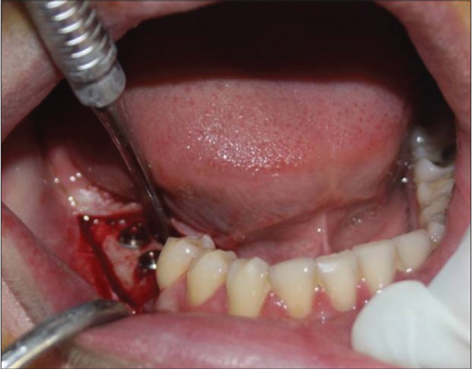 هزینه کاشت ایمپلنت دندان