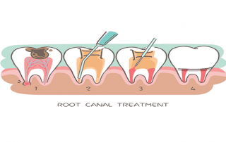 جراحی کانال ریشه دندان