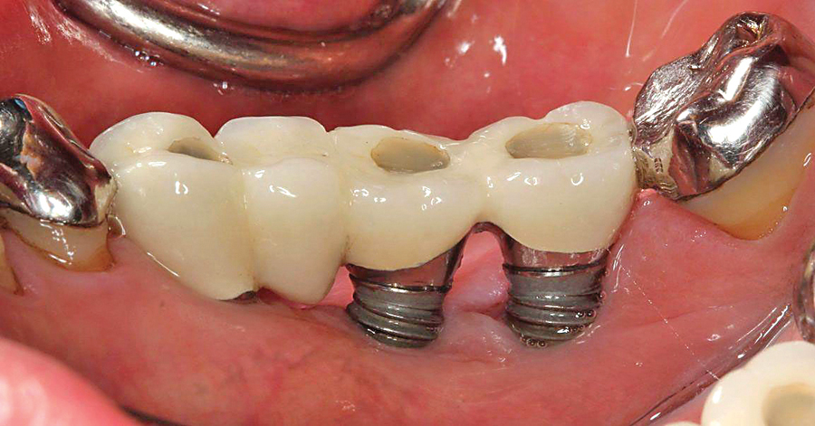 کاشت دندان مصنوعی یا ایمپلنت دندان