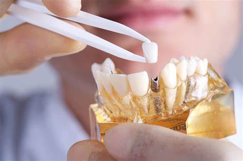 کاشت ایمپلنت دندان چیست؟