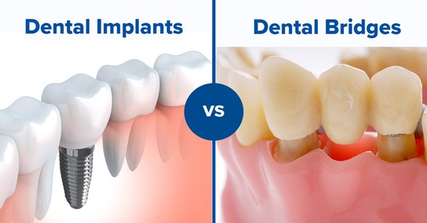 ایمپلنت یا بریج دندان؟