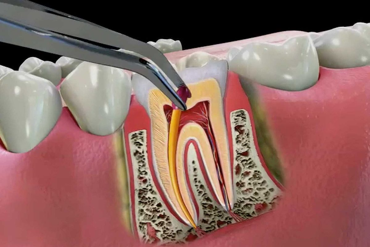 مراحل جراحی دندان عقل