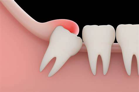 مراحل درمان دندان عقل