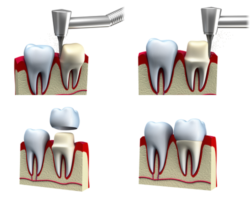 بریج و روکش دندان چیست