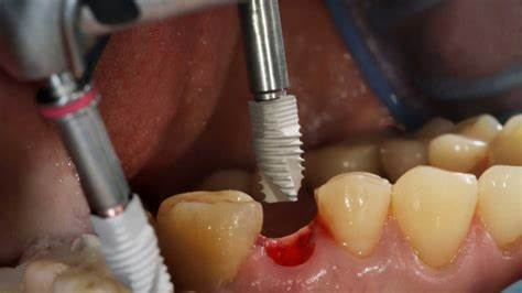 ماندگاری ایمپلنت دندان
