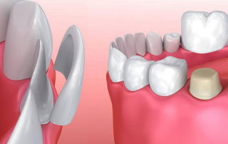 ارتودنسی یا لمینت دندان