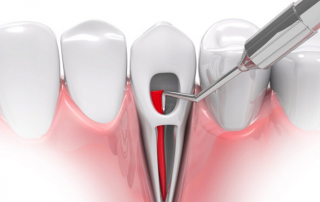 درمان کانال ریشه دندان