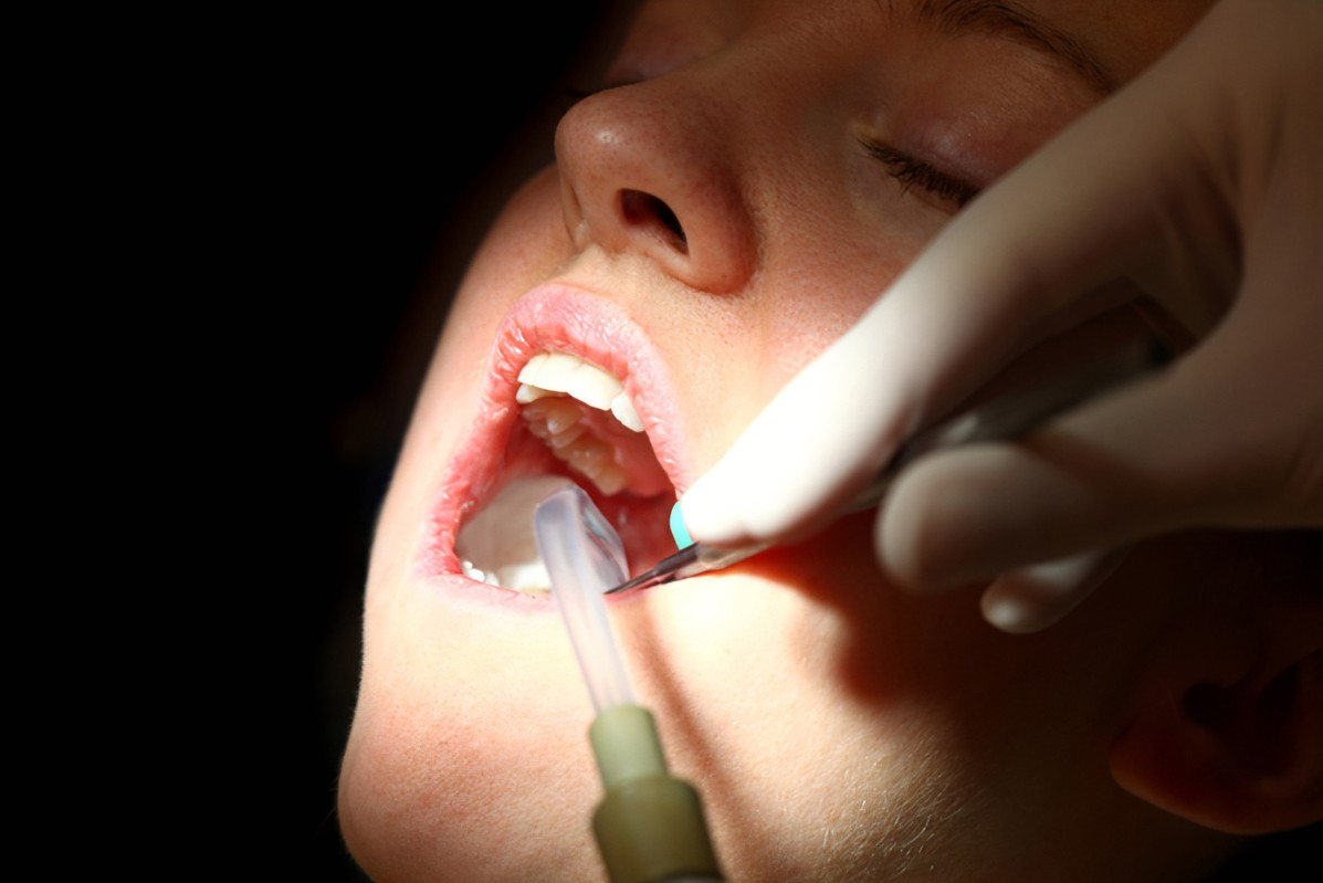 جراحی دندان و کانال ریشه
