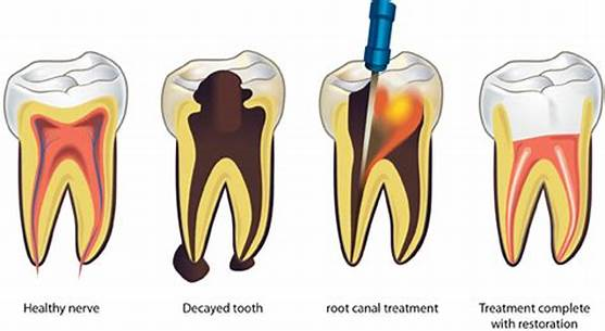 مراحل درمان کانال ریشه دندان