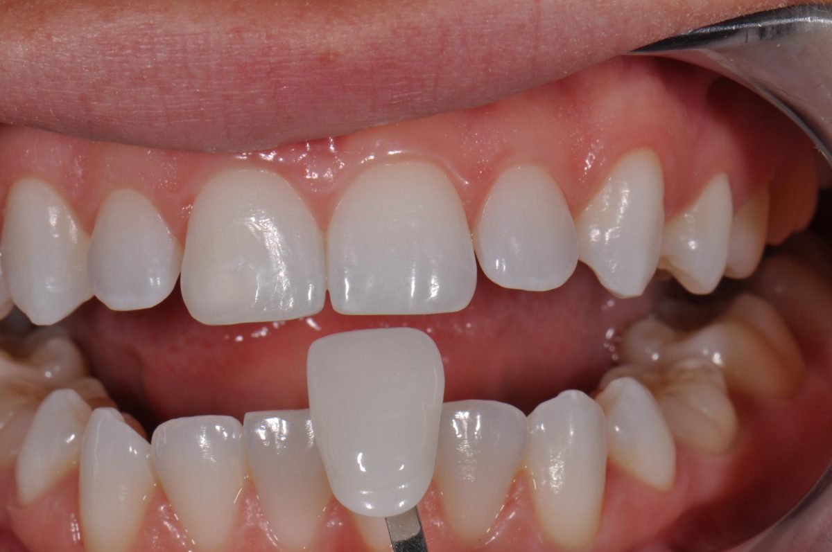 روکش لمینت دندان چیست