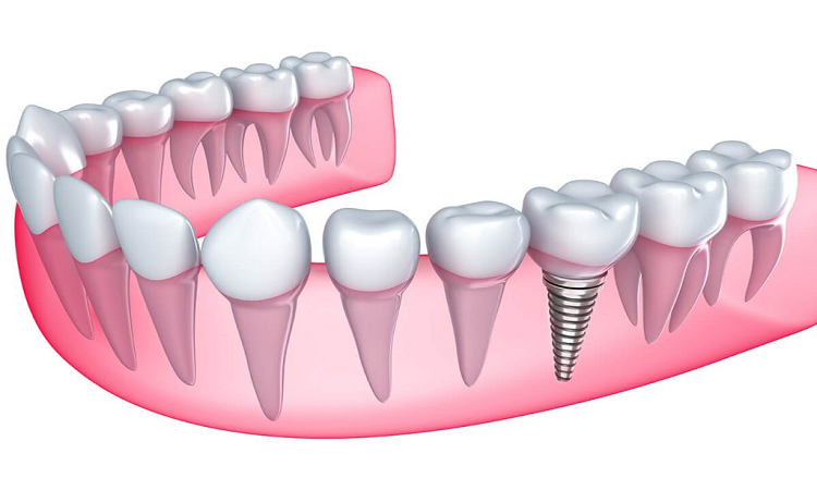 طول عمر ایمپلنت دندان