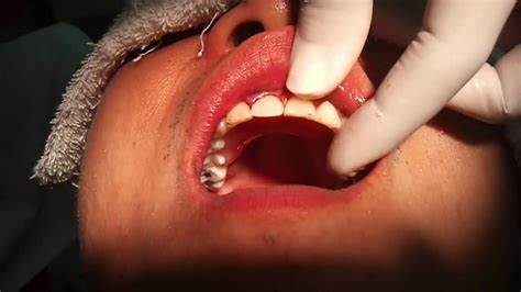 روش های جدید کشیدن دندان