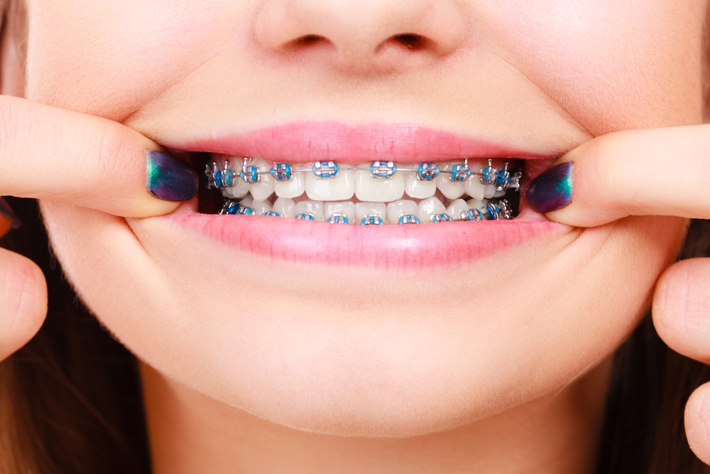 کامپوزیت یا ارتودنسی دندان