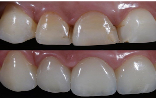 کامپوزیت دندان چیست