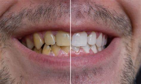 جلوگیری از عوارض بلیچینگ دندان
