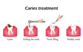 درمان پوسیدگی دندان