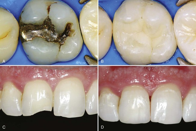 فرایند باندینگ دندان