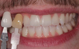 بلیچینگ و سفید کردن دندان