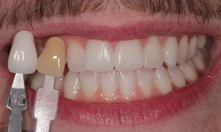 بلیچینگ و سفید کردن دندان