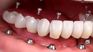 قرارگیری تاج دندان مصنوعی