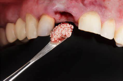 درمان دندان با پیوند استخوان