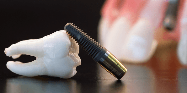 کاشت دندان برای بیماران 